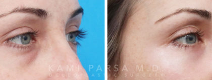 Gallery Before/After Photos | Kami Parsa MD Los Angeles, Beverly Hills