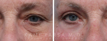 Quadfecta Lift Before/After Photos | Kami Parsa MD Los Angeles, Beverly Hills