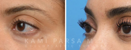 Trifecta Lift Before/After Photos | Kami Parsa MD Los Angeles, Beverly Hills