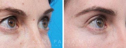Gallery Before/After Photos | Kami Parsa MD Los Angeles, Beverly Hills