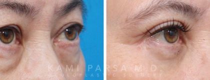 Quadfecta Lift Before/After Photos | Kami Parsa MD Los Angeles, Beverly Hills